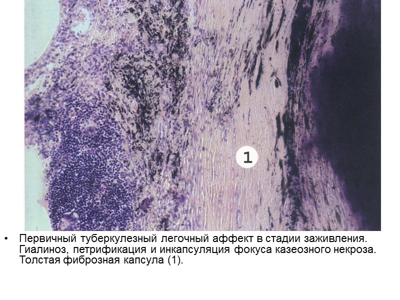 Первичный туберкулезный легочный аффект в стадии заживления. Гиалиноз, петрификация и инкапсуляция фокуса казеозного некроза.